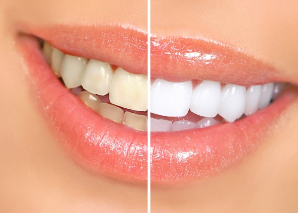 teeth whitening chicago